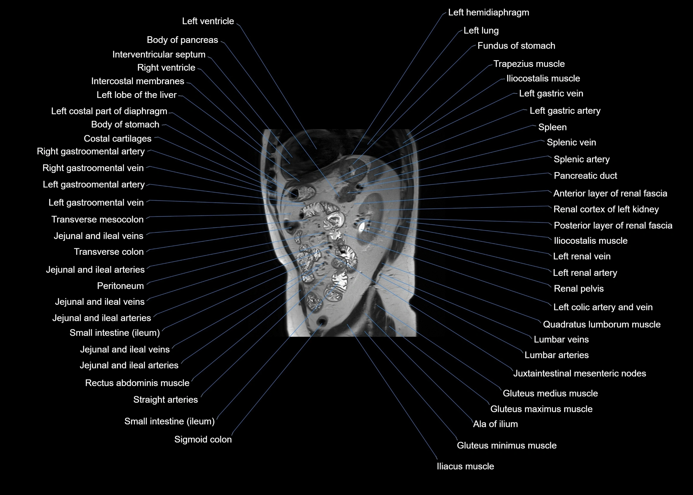 MRI abdomen sagittal cross sectional anatomy  radiology  image-img-00001-00048.webp